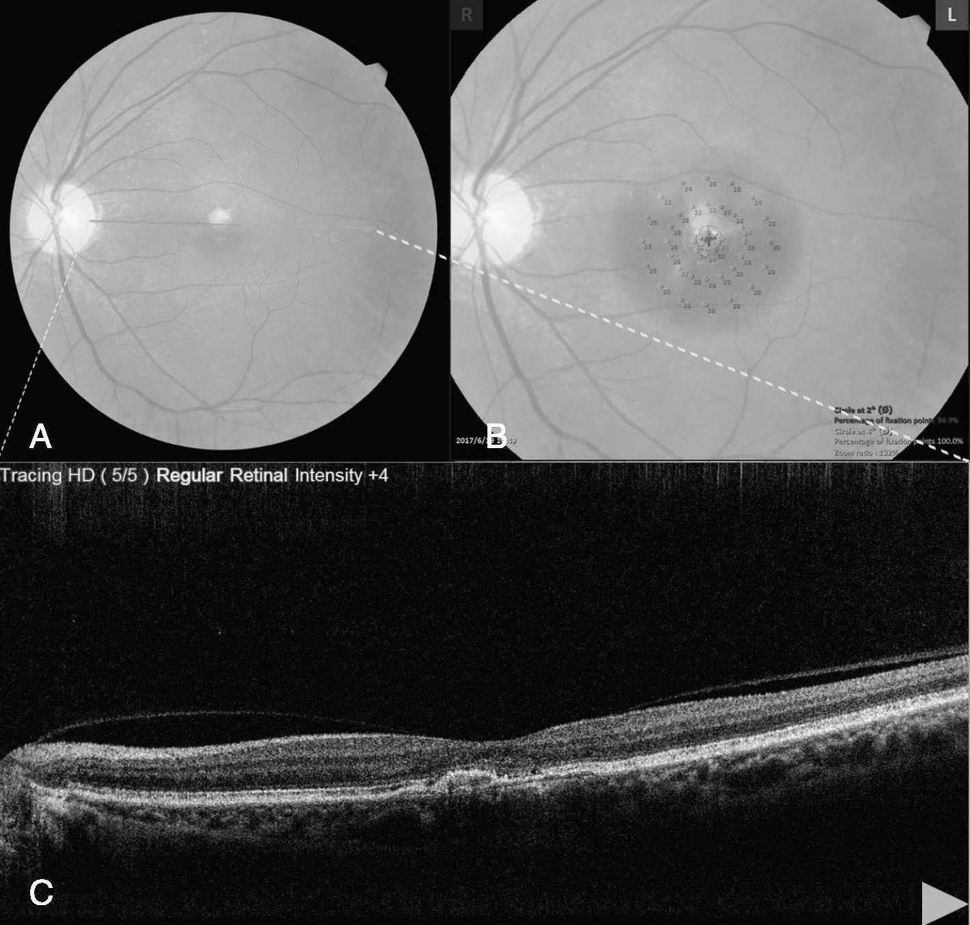 病例2-2-14 診斷:左眼濕性AMD，抗VEGF治療后。